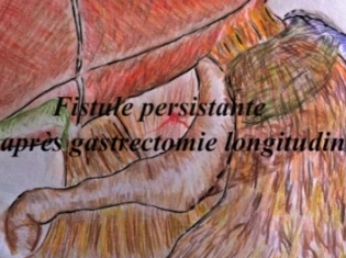 Fistule chronique après gastrectomie longitudinale Fistule chronique après gastrectomie longitudinale