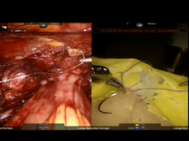 Florence Robotic Intracorporeal Neobladder Florin