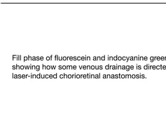 Fluorescein and Indocyanine Green Angiography of Chorioretinal Anastomosis Fluorescein and Indocyanine Green Angiography of Chorioretinal Anastomosis