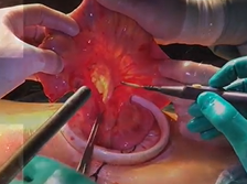 Fluorescence Angiography during Transanal Trans-stomal Proctectomy and Ileal Pouch Anal Anastomosis Fluorescence Angiography during Transanal Trans-stomal Proctectomy and Ileal Pouch Anal Anastomosis