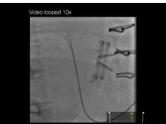 Fluoroscopy of a Mechanical Mitral Valve