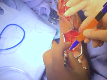 Forearm Radiobasilic Fistula Creation Forearm Radiobasilic Fistula Creation