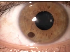 Free-Floating Iris Cyst in the Anterior Chamber Free-Floating Iris Cyst in the Anterior Chamber