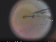Free ILM Flap Technique Under PFCL for Recurrent and Difficult Macular Holes