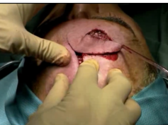 Frontalis Myocutaneous Transposition Flap Surgical Technique