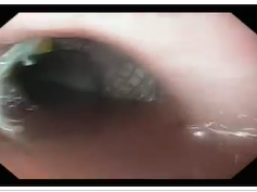 Fully Covered Stent after Gastric Bypass