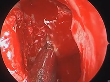 Functional Endoscopic Sinus Surgery (FESS) with Microdebrider