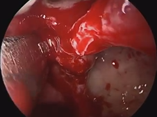 Functional Endoscopic Sinus Surgery for Chronic Rhinosinusitis