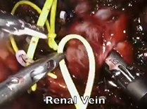 Functioning left renal hilar Extra-adrenal Paraganglioma