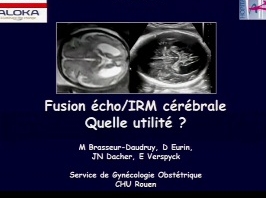 Fusion écho / IRM cérébrale - Quelle utilité? Fusion écho / IRM cérébrale - Quelle utilité?