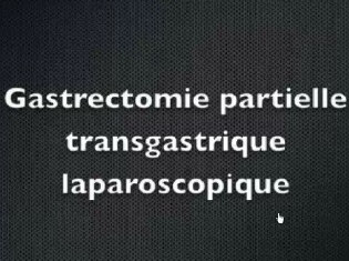 Gastrectomie partielle trans-gastrique par coelioscopie pour GIST de la face postérieure de la grosse tubérosité Gastrectomie partielle trans-gastrique par coelioscopie pour GIST de la face postérieure de la grosse tubérosité