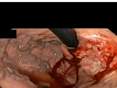 Gastric Adenocarcinoma