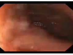 Gastric Bypass Following Stent Removal