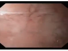 Gastric Diverticulum after Gastric Bypass