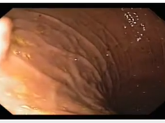 Gastric Gastrointestinal Stromal Cell Tumor (GIST)