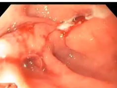 Gastric Outlet Obestruction from Pyloric Ulcers