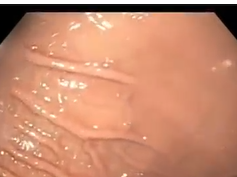 Gastric Outlet Obstruction from Post-pyloric Gastrostomy Tube