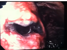 Gastric Submucosal Hematoma