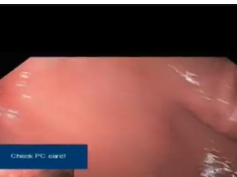 Gastric Ulcer Following Gastrostomy Tube Removal