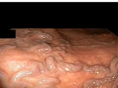 Gastric Varices