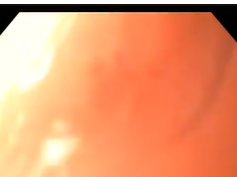 Gastro Cutaneous Fistula