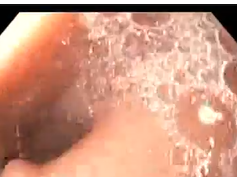 Gastro Gastric Fistula after Gastric Bypass