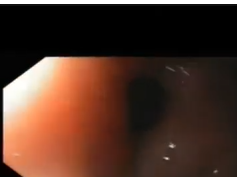 Gastro Gastric Fistula and Gastro-jejunal Anastomosis Ulceration after Gastric Bypass Gastro Gastric Fistula and Gastro-jejunal Anastomosis Ulceration after Gastric Bypass