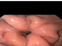 Gastro Gastric Fistula and Involuted Gastro-jejunal Anastomosis after Gastric Bypass Gastro Gastric Fistula and Involuted Gastro-jejunal Anastomosis after Gastric Bypass