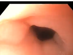 Gastro-gastric Fistula with Associated Anastomotic Ulcer Following Gastric Bypass Gastro-gastric Fistula with Associated Anastomotic Ulcer Following Gastric Bypass