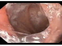 Gastrointestinal Staples on Endoscopy