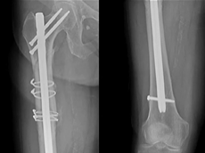 GE Healthcare X-ray: Auto Image Paste, Femur & Tibia - Table Mode