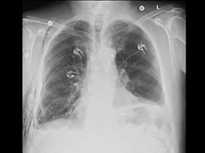 GE Healthcare X-ray: Dual Energy Subtraction PICC Line Placement