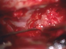 Geniculate ganglion tumor resection and interposition nerve graft
