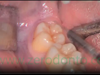 Germectomy: flap design and elevation