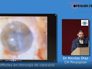 Gestion des complications de la chirurgie de la cataracte par vitrectomie
