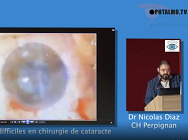 Gestions des cas diffciles en chirurgie de cataracte