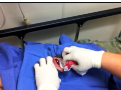 Giant Back Pimple Popped? Abscess Removal & Drainage!