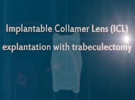 Glaucome - Explantation d'une lentille Collamer implantable avec trabéculectomie Glaucome - Explantation d'une lentille Collamer implantable avec trabéculectomie