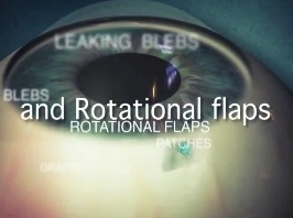 Glaucome - Fuite des bulles : greffes, correctifs et volets de rotation Glaucome - Fuite des bulles : greffes, correctifs et volets de rotation