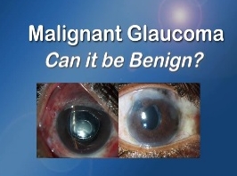 Glaucome - Glaucome malin : peut-il être malin? Glaucome - Glaucome malin : peut-il être malin?