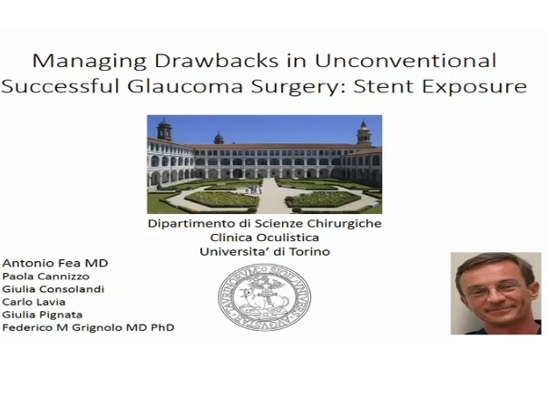 Glaucoma - Managing Drawbacks in Unconventional Successful Glaucoma Surgery: Stent Exposure Glaucoma - Managing Drawbacks in Unconventional Successful Glaucoma Surgery: Stent Exposure