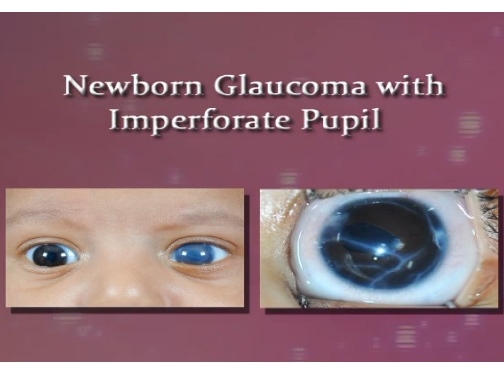 Glaucoma - Newborn Glaucoma With Imperforate Pupil