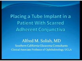 Glaucome - La pose d'implants tubulaires du glaucome chez les patients ayant des adhérences de la conjonctive ou de la cicatrisation Glaucome - La pose d'implants tubulaires du glaucome chez les patients ayant des adhérences de la conjonctive ou de la cicatrisation