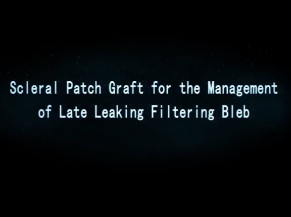 Glaucoma - Scleral Patch Graft for the Management of Late Leaking Filtering Bleb Glaucoma - Scleral Patch Graft for the Management of Late Leaking Filtering Bleb