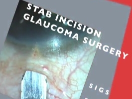 Glaucome - L'incision lors de la chirurgie du glaucome
