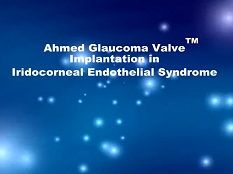 Glaucome - Implantation d'une Valve d'Ahmed pour Glaucome (AGV) dans le syndrome endothélial iridocornéal Glaucome - Implantation d'une Valve d'Ahmed pour Glaucome (AGV) dans le syndrome endothélial iridocornéal
