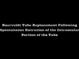 Glaucome - Remplacement de tube de Baerveldt en suivant l'extrusion spontanée d'une portion intraoculaire du tube Glaucome - Remplacement de tube de Baerveldt en suivant l'extrusion spontanée d'une portion intraoculaire du tube