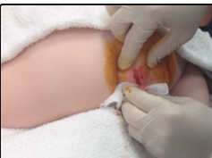 gluteal abscess in a child