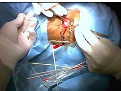 Google Glass During Scleral Buckling Google Glass During Scleral Buckling