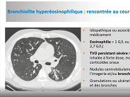 Granulomatose à éosinophiles avec polyangéite (Churg et Strauss)